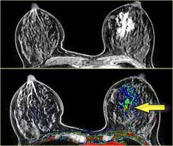 Breast MRI