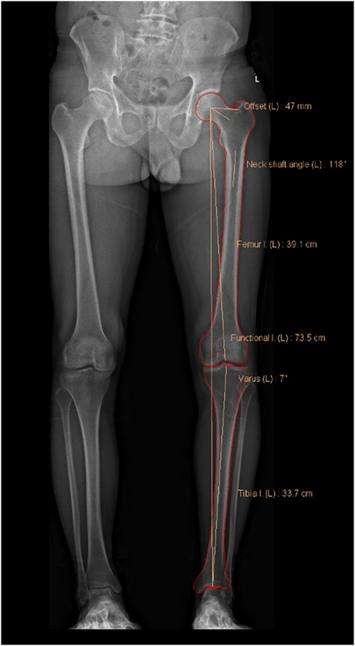 Lower Limb Scanogram